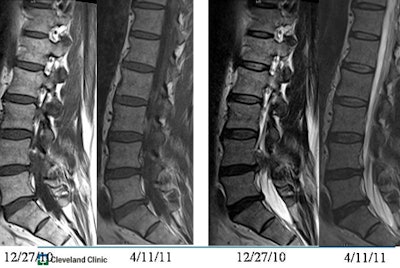 Spine MRI of patients presenting with back and left-leg pain on December 27, 2010. Patients were treated conservatively and both pain and disk herniation resolved before repeat imaging on April 11, 2011. All images courtesy of Dr. Michael Modic.