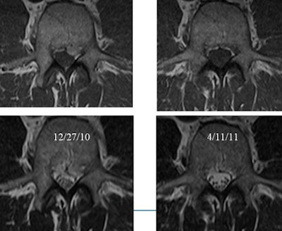 Imaging for disk herniation