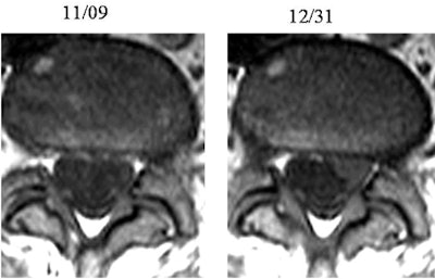 Patient had left radicular symptoms at presentation but no herniation at MRI. At follow-up imaging, pain decreased significantly but disk herniation became visible.