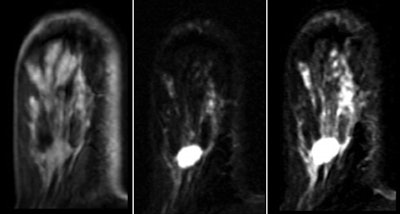 Images are of a 39-year-old woman with a BI-RADS 3 lesion. Axial unenhanced (left) and subtracted two-minute (middle) and five-minute (right) T1-weighted dynamic fat-suppressed MRI shows smooth oval mass (diameter, 1.1 × 1.0 cm) in lower outer quadrant of right breast with plateau (type II) curve type. All images courtesy of AJR.