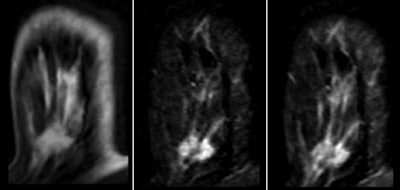 Same 39-year-old patient 23 months after initial study. Unenhanced (left) and subtracted two-minute (middle) and five-minute (right) axial T1-weighted dynamic fat-suppressed MRI shows increase in size of lesion (1.4 × 1.1 cm), irregular border, and washout (type III) curve type.