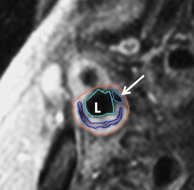 2014 03 04 11 23 26 632 Figure2b Bluemke 400