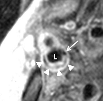 Transverse gadolinium-enhanced T1-weighted MR images show carotid artery bifurcation in a 72-year-old man. Above, low-signal-intensity calcium (arrow) and lipid core (arrowheads) can be seen in internal carotid artery (ICA) lumen (L). Contouring of the ICA is seen in the image below. The outer adventitial wall (orange), lipid core (purple), calcification (arrow), and vessel lumen (teal) are visible. Images courtesy of Radiology and Dr. David Bluemke, PhD.
