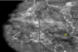 2014 03 04 17 16 09 15 2014 03 06 Breast Us Thumb