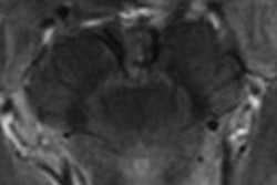 2014 03 04 18 05 40 695 7 T Parkinsons Cosottini Rad 20140305010618