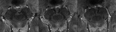 Seven-tesla MR in vivo images show three levels of the substantia nigra in a 61-year-old male Parkinson's patient. The loss of normal anatomy of the substantia nigra with Parkinson's is characterized by the disappearance of an oval-shaped bright spot in the lateral part of the substantia nigra at level I (left) and by the loss of the hyperintense intermediate layer of the substantia nigra at level II (center). Images courtesy of Radiology.
