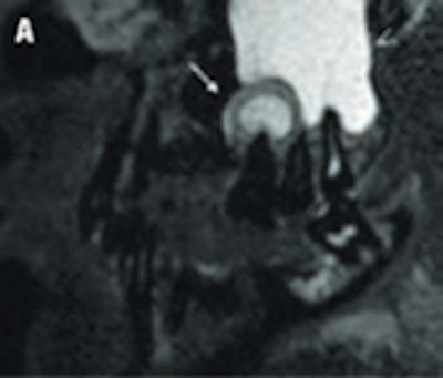T2-weighted MR image of periapical granuloma