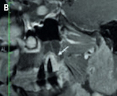 High-resolution (3-tesla) MRI of a patient with an inflammatory endoperiodontal lesion at tooth 017 (arrow). Sagittal T2-weighted space (A), T1-weighted plus gadolinium (B). Images courtesy of Dr. Stefan Rohde.