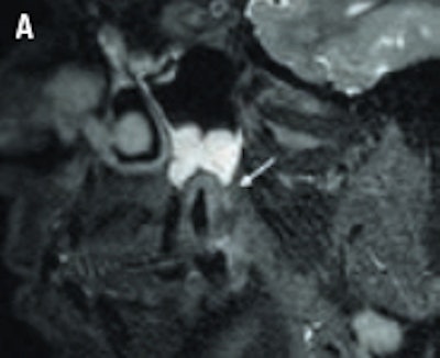 3-tesla sagittal T2-weighted MRI of endoperiodontal lesion