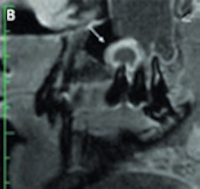 T2-weighted (A) and contrast-enhanced T1-weighted images (B) of a patient with a periapical granuloma at tooth 015 (arrow) and odontogenic sinusitis in the maxillary sinus (open arrow). Images courtesy of Dr. Stefan Rohde.