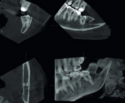 An example of cone-beam CT. In this instance, the lower left third molar (d. 38) was imaged after panoramic radiograph with CBCT. The arrows mark the mandibular canal. Images courtesy of Dr. Anni Suomalainen.