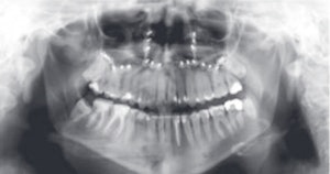 Panoramic radiograph