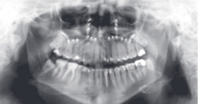 Panoramic radiograph