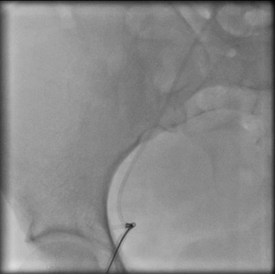 Interventional retrieval of portacath fragment