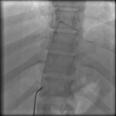 Interventional retrieval of portacath fragment