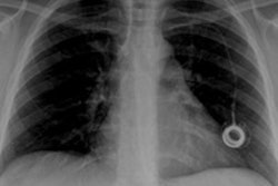 2014 03 09 23 57 42 318 2014 03 10 Cxr Thumb