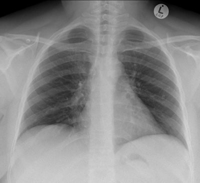 Postoperative chest radiograph.