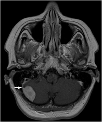 Meningioma seen at whole-body MRI in a 43-year-old man who underwent surgery. Image courtesy of Dr. Andrzej Cieszanowski.