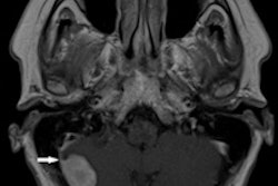 2014 03 10 09 26 29 176 Andrzej Brainglioma 200