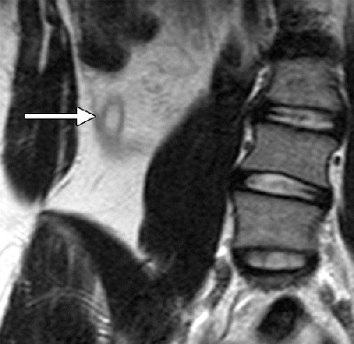 MR image of a 13-year-old girl with acute appendicitis and one day of intermittent abdominal pain. Coronal fast spin-echo T2-weighted MRI of the right lower quadrant shows a dilated, fluid-filled appendix (arrow) with decreased signal intensity in the surrounding fat, indicating inflammation and thickening of the lateral conal fascia. Image courtesy of Radiology.