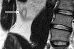 2014 03 19 16 36 54 402 Mri Appendicitis Rad O Rth 400 20140319233849