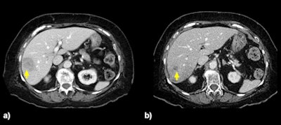 An 82-year-old woman with a 4.5 x 3.3-cm solitary tumor (a) in the right lobe. CT five months later (b) shows a reduction in size to 1.3 x 1.3 cm after two right lobar treatments at 93 Gy followed by 119 Gy. This patient had isolated liver metastases and remained free of extrahepatic disease 666 days after the first Y-90 treatment. Images courtesy of Dr. Robert Lewandowski.
