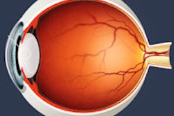 2014 03 28 15 50 27 261 Cataract 200