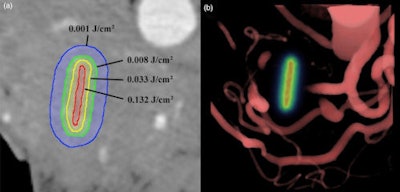 A single axial slice (left) of the pancreas from the pretreatment CT scans is overlaid with computed contours of light fluence levels around the light-emitting fiber location. This was simulated using blood content information for tissue absorption from contrast CT. A volume rendering (right) of the blood vessels around the pancreas in the same patient is overlaid with the light dose map in the fiber location. Image courtesy of Dartmouth-Hitchcock Norris Cotton Cancer Center.