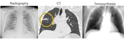 Conventional chest radiograph (left) and simulated tomosynthesis image (right) for the same patient. Middle image shows a coronal CT slice that demonstrates early pneumonia. Note how this abnormality is clearly demonstrated in the tomosynthesis image but is more subtle in the radiograph. Image courtesy of Dr. Gregory Kicska, PhD.
