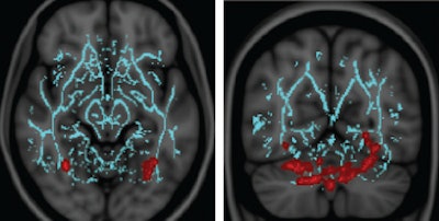 Vestibular abnormalities correlated with decreased fractional anisotropy values in cerebellar regions responsible for sensorimotor processing and central and/or axial balance, as well as the fusiform gyrus, which is responsible for visually guided locomotion and stereoscopic vision. Above are DTI coronal (left) and sagittal (right) views of the fusiform gyri. Images courtesy of Radiology.