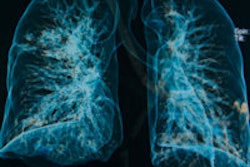 2014 04 15 15 51 17 897 Lung Xray 3 D 200