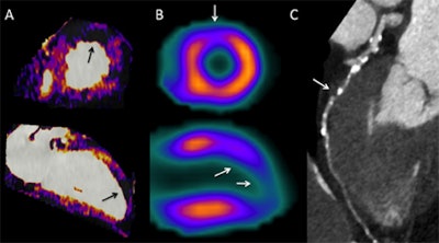 A 68-year-old man with diabetes experiencing shortness of breath after mild exercise. Pharmacological stress dual-energy CT myocardial iodine distribution maps (A) demonstrate a circumscribed area of decreased iodine content in the apicoanterior left ventricular myocardium consistent with a perfusion defect (black arrows). Stress SPECT images (B) confirm an area of ischemia (white arrows). Coronary CT angiography (C) demonstrates critical stenosis of the proximal portion of the left anterior descending artery (arrows).