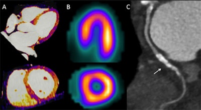 A 62-year-old man with a history of coronary revascularization and recent onset of chest discomfort. Pharmacological stress dual-energy myocardial iodine distribution maps (A) demonstrate homogenous iodine distribution consistent with normal myocardial perfusion. Stress SPECT images (B) also demonstrate normal myocardial perfusion. Coronary CTA (C) demonstrates patent stents (arrow) in the circumflex branch. All images courtesy of Dr. Carlo De Cecco.