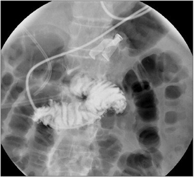 A surgical retained foreign object in plain sight during feeding tube positioning under fluoroscopy. Image courtesy of Dr. Theodore Marentis.
