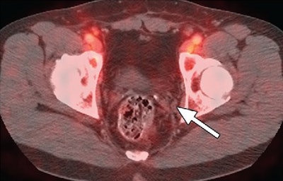 Indium-111 with SPECT/CT