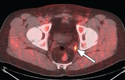Images of a patient who underwent a radical prostatectomy. Fused PET/CT scan with FACBC (above) shows 5-mm recurrence in the left obturator lymph node. There is no uptake of indium-111 with SPECT/CT (below) in same region (arrow). Images courtesy of Radiology.