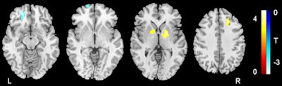 Images show differences in ALFF between ADHD and control subjects. Regions of increased ALFF in ADHD subjects are indicated by red, orange, and yellow; decreased ALFF areas are depicted in white, light blue, and dark blue. Images courtesy of Radiology.