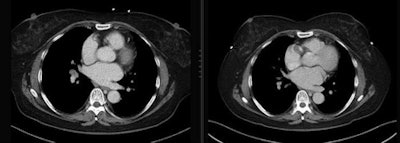24-year-old woman with malignant melanoma. Patient is wearing (right) and not wearing (left) a bra during the CT scan. All images republished with permission of the American Roentgen Ray Society.