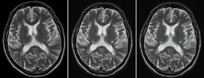 Brain MRI on same patient from 2011 (left) and 2013 (center). Overlaid changes (green) calculated by the EigenBlockCD algorithm (right). All images courtesy of Varvara Nika.