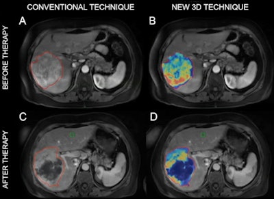 MR images of a patient with primary liver cancer. Images A and B show the patient before being treated with chemoembolization. The new 3D technique helped quantify the volume and distribution of viable tumor tissue (shown in red and yellow). Images C and D are MR scans acquired after the treatment. The 3D method helped the radiologists quantify the vast central destruction of the tumor after treatment. Dead tumor is shown in blue. Image courtesy of Dr. Julius Chapiro.