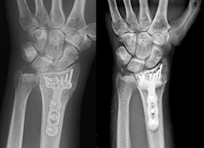 At left, frontal radiograph of a 41-year-old woman with healing comminuted distal radial fracture, post internal fixation. At right, coronal reconstruction image from tomosynthesis. Images courtesy of Dr. Alice Ha.