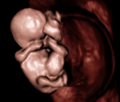 A 9-week embryo with a physiologic type umbilical hernia from 'Foundations of Ultrasonic Fetal Screening for Congenital Anomalies,' presented by Dr. Birnholz in Tel Aviv in April 2014. All images courtesy of Dr. Birnholz.