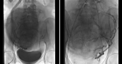 Bilateral uterine artery embolization for massive uterine fibroids.