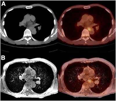 FDG-PET/CT (A) and PET/MR (B) images show esophageal cancer in a 63-year-old man. On PET/MRI, tumor stage was interpreted as T3. Pathologic diagnosis was squamous cell carcinoma, stage IIIA. Image courtesy of JNM.