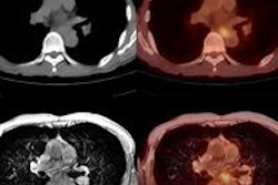 2014 05 30 15 45 42 282 Pet Ct Mri Esophageal Jnm 450 20140530225035