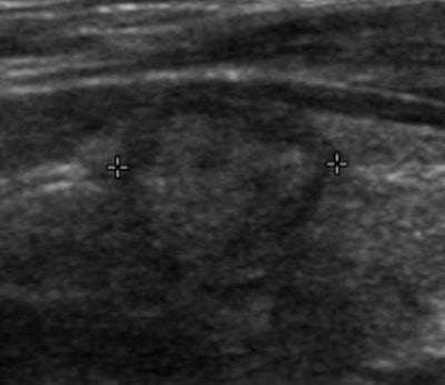 Transverse ultrasound image of an SRU criteria-negative thyroid cancer. Incidentally detected at CT, this 1.2-cm thyroid nodule is solid in composition. It does not meet the SRU recommendations for fine-needle aspiration biopsy. The postsurgical pathologic result was papillary cancer. Image courtesy of Dr. Manisha Bahl.