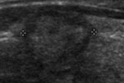 2014 06 04 15 41 52 268 Thyroid 400 20140604224438
