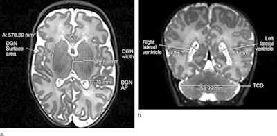 Axial T2-weighted MR image (left) shows deep gray nuclei width, anteroposterior distance, and surface area. Coronal T2-weighted MR image (right) shows lateral ventricle atrial measures and transverse cerebellar diameter. Images courtesy of RSNA.