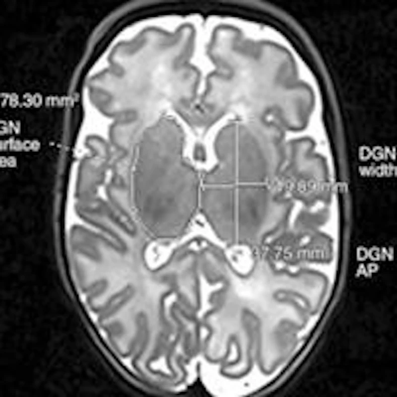 MRI finds brain abnormalities in late preterm infants | AuntMinnie
