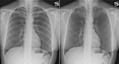 Chest images before and after applying Carestream's bone suppression feature, which is designed to create a companion image that suppresses the appearance of posterior ribs and clavicles, while enhancing visualization of soft tissue. Images courtesy of Carestream.
